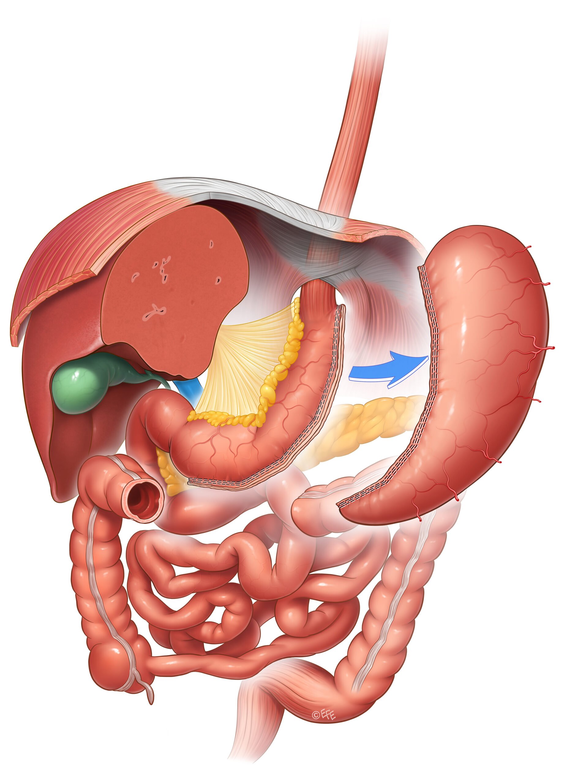 Diagram of a Laparoscopic Sleeve Gastrectomy