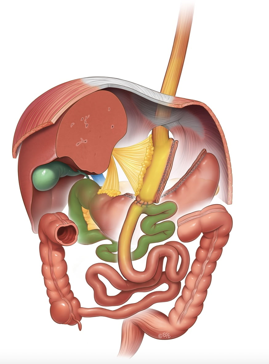 Diagram of a Laparoscopic One Anastomosis Gastric Bypass